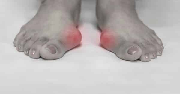 3-Simple-Foot-Exercises-to-help-people-with-Bunions-feature-image