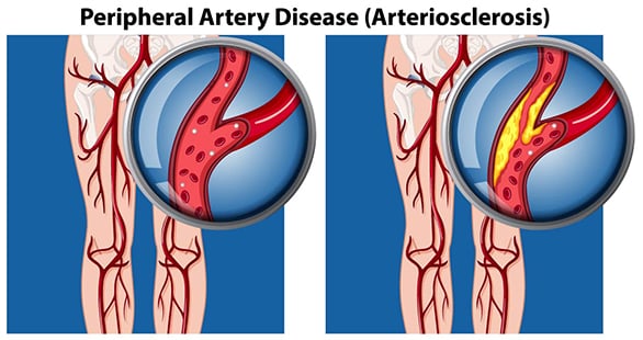 A-Comparison-of-Peripheral-Artery-Disease-01