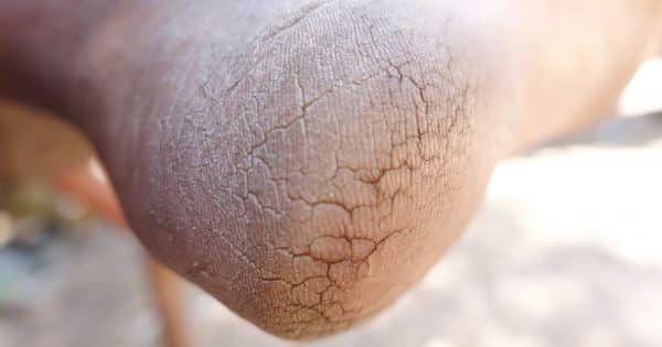 Are-Your-Shoes-Making-Your-Feet-Crack-Up-featured-image