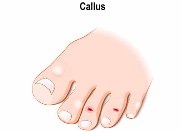 Callus-