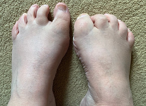 Charcot-3 Charcot-3