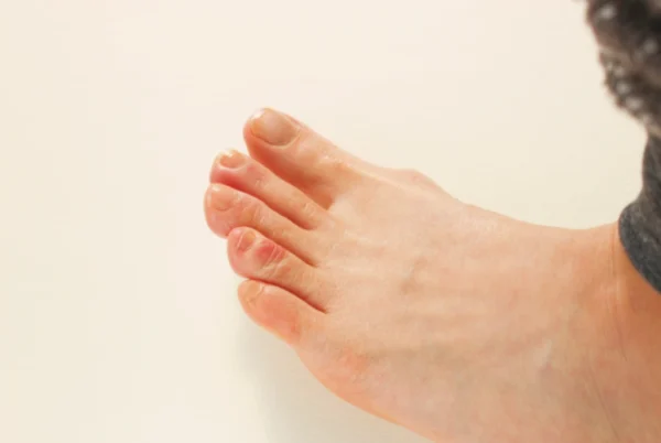 Chilblains Symptoms, Causes & Prevention in Samford