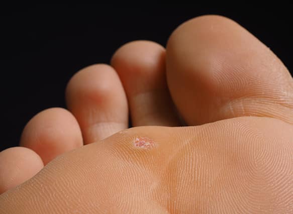 Closeup-of-foot-with-a-infected-wart-placed-under-toes-isolated