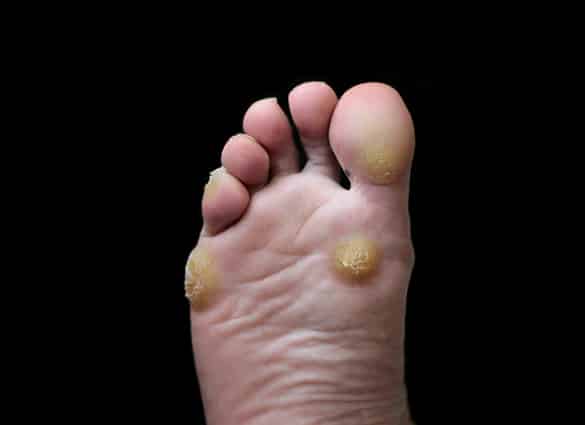 Corns and Callus | Foot Health Clinic 