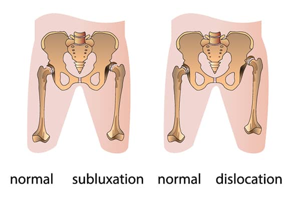 Developmental-Dysplasia-of-Hip