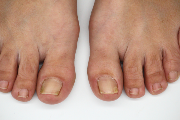 Fungal Infections and Excessive Nail Thickening