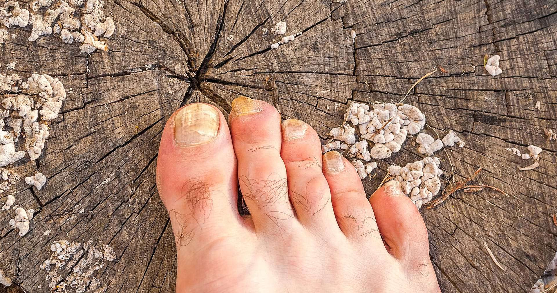 Fungal Toenail Treatment Brisbane Northside Foot Health Clinic