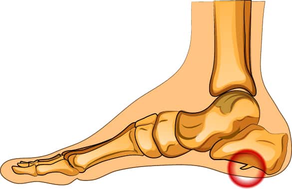 Heel-Spurs-infographic