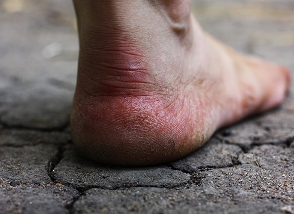 Human-foot-with-cracks-and-fissures