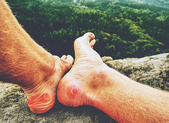 Man-hiker-sweaty-legs-with-horrible-painful-callus-resting-on-peak_