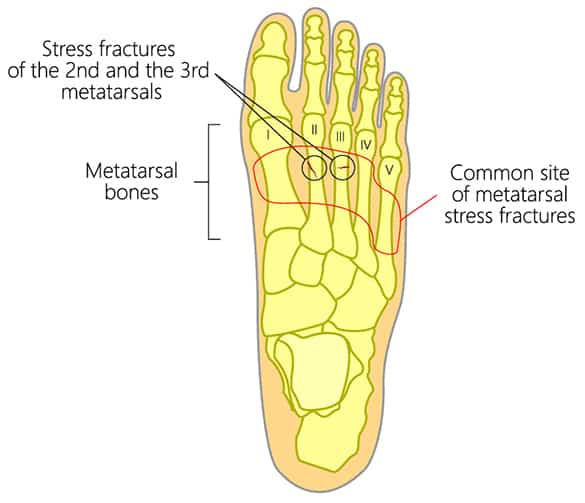 Metatarsal-Stress-fractures