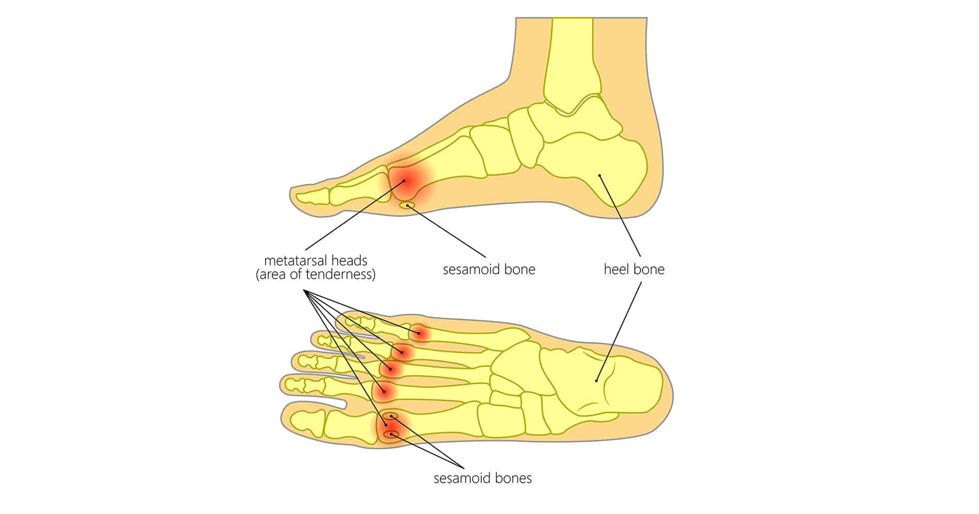 Metatarsalgia Treatment Brisbane Brisbane North Podiatry Clinic