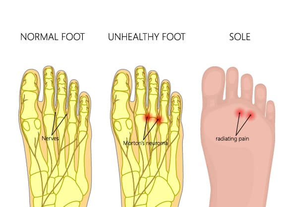 Mortons-neuroma-