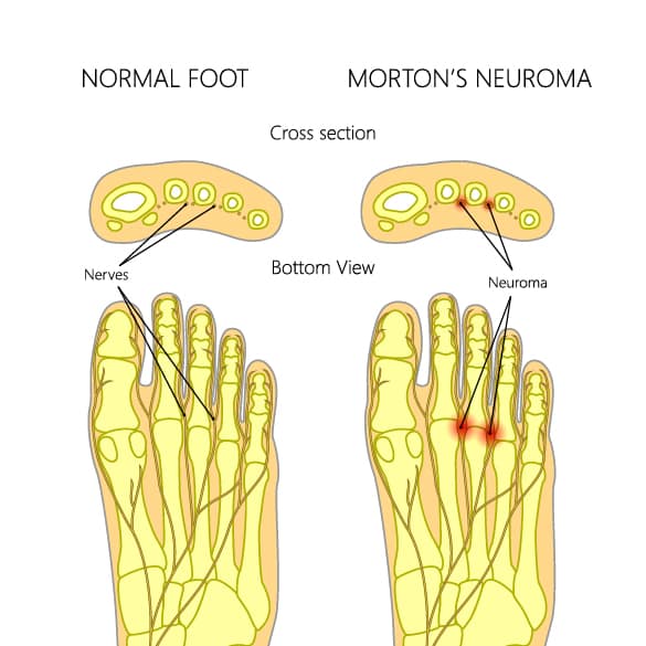 Mortons-neuroma-with-cross-section.