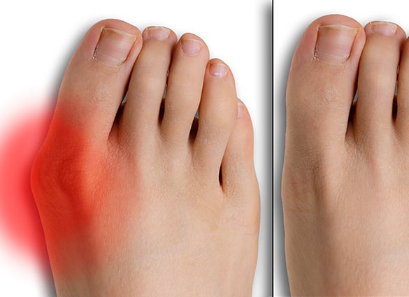 Pain-caused-by-hallux-valgus-comparison-before-and-after-surgery