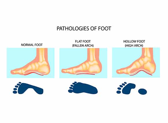 Pathologies-of-Foot-illustration