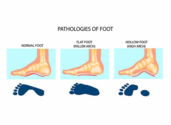 Cavus foot hotsell support