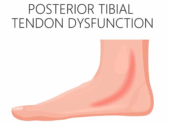 Posterior-Tibial-Tendon-Dysfunction-02