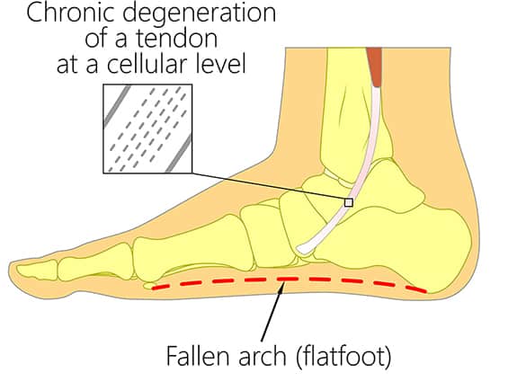 Posterior-Tibial-Tendon-Dysfunction-04