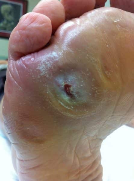 Removal-of-thick-callus-–-hiding-an-ulcer