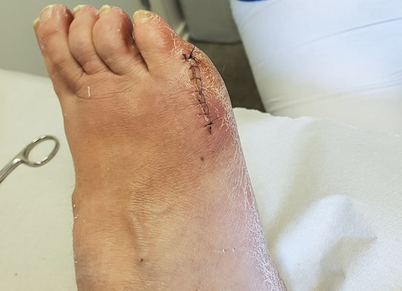 Stiches-on-right-foot-after-a-bunion-surgery