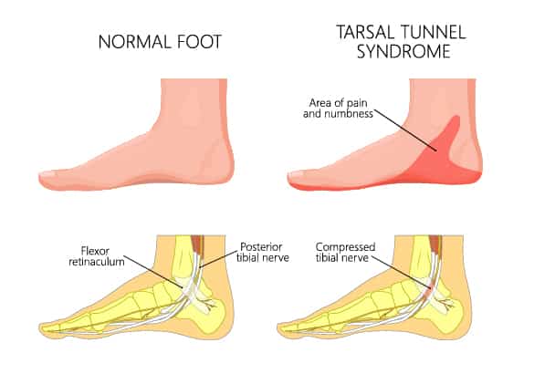 Tarsal-Tunnel-Syndrome-illustration