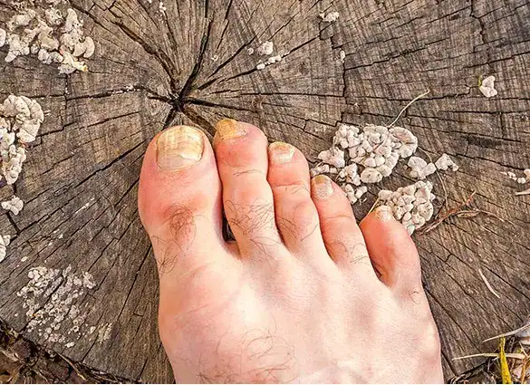 Toes-of-male-foot-infected-with-a-nail-fungus Toes-of-male-foot-infected-with-a-nail-fungus