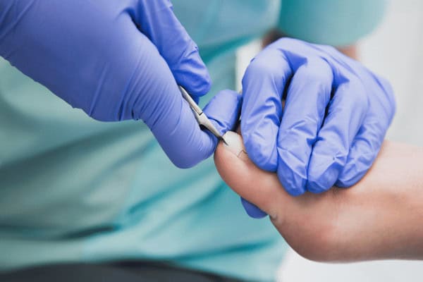 Understanding Ingrown Toenails