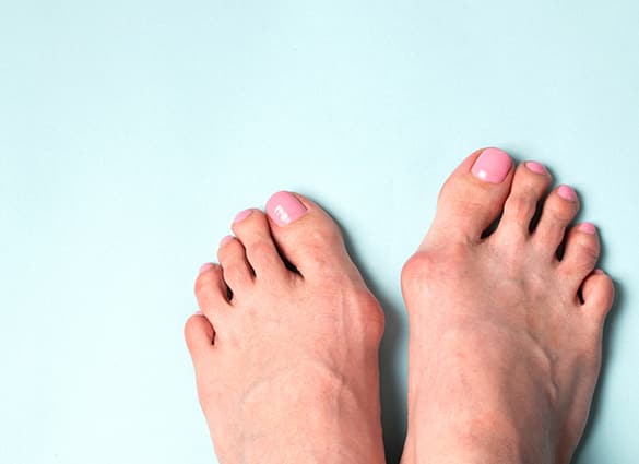Valgus-deformity.-Flatfoot.-Orthopedic-problem-and-disease