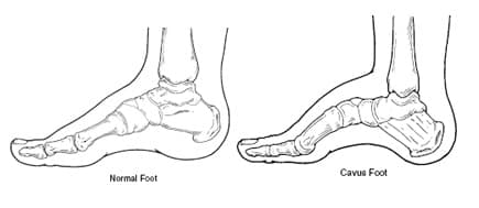 cavus-foot-normal-foot