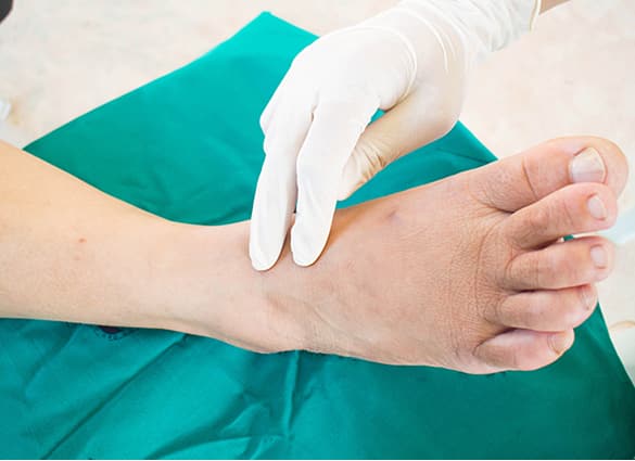 Diabetes and Feet – Cellulitis