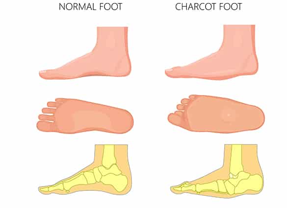 charcot-foot