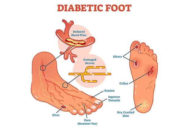 Diabetes Mellitus — Signs, Symptoms & Treatment | Arizona Foot Doctors