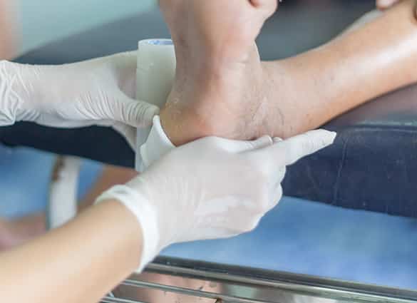 diabetes-ulcerstreatment-infected-wound-of-diabetic-foot