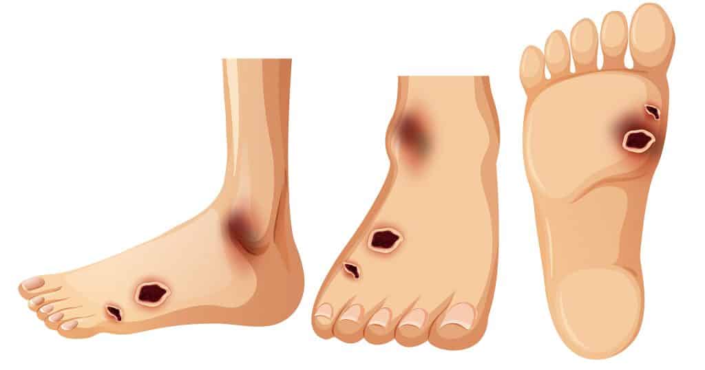 diabetic-foot-featured-image