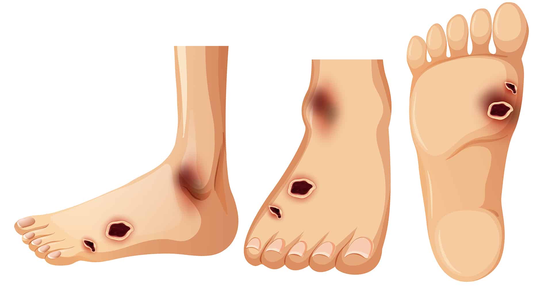 diabetic-foot-featured-image