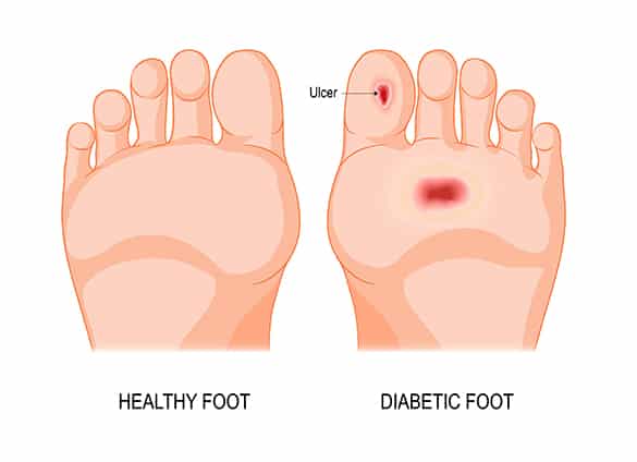 diabetic-foot