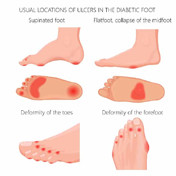 diabetic-ulcer-foot-diagram diabetic-ulcer-foot-diagram
