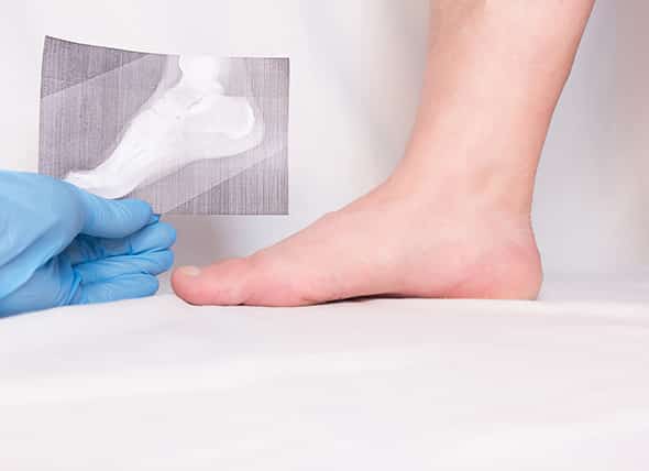 Expert Dorsal Heel Spur Surgery Solutions