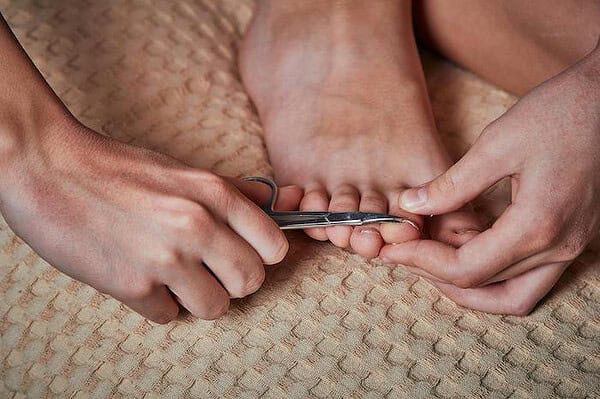 Does ingrown toenail surgery hurt