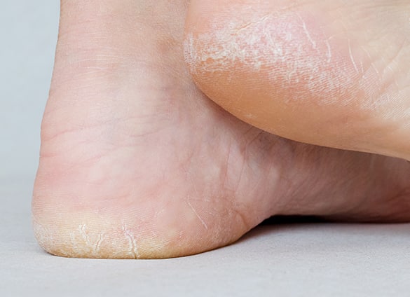 Heel Cracks | Foot Health Clinic 