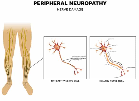 foot-Diabetic-Peripheral-Neuropathy-4
