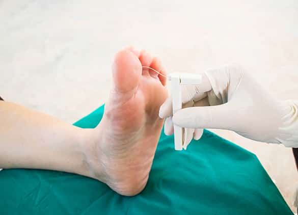 foot-Diabetic-Peripheral-Neuropathy-7 foot-Diabetic-Peripheral-Neuropathy-7