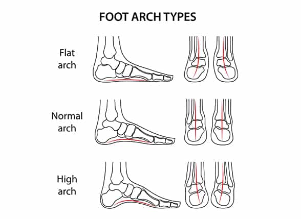 foot-arch-types-illustration