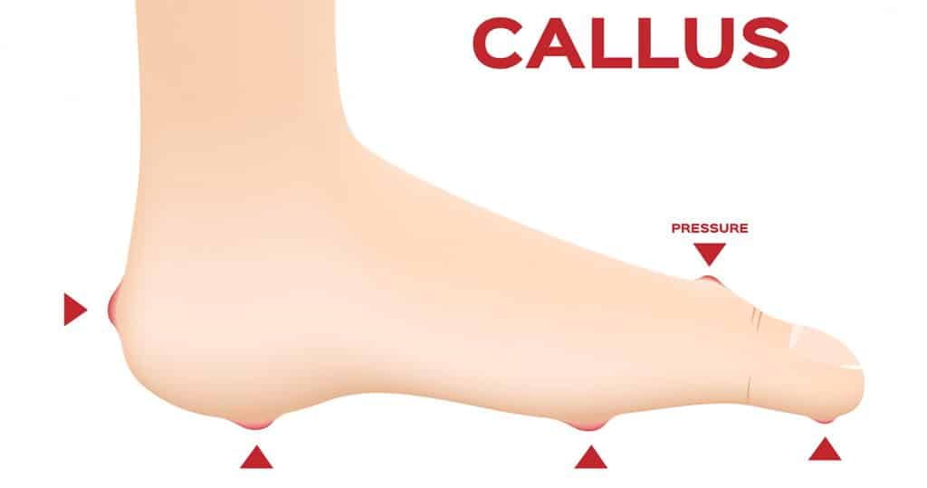 foot-callus-vector-featured-image