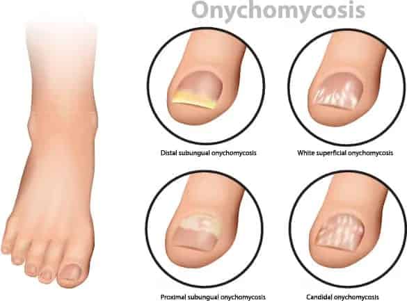 fungal nail infections treatment Brisbane North