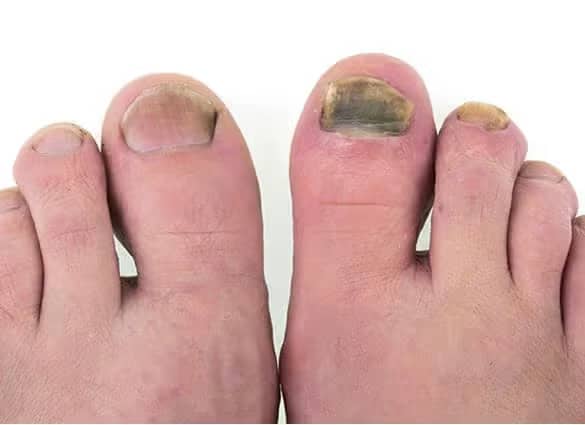 fungal nail treatment brisbane Northside