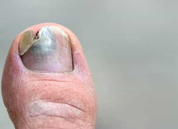 fungal nail treatment brisbane north