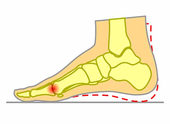 hallux-litmus-2 hallux-litmus-2