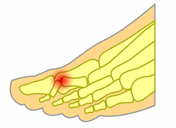 hammertoes-13